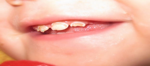 baby bottle tooth decay symptoms